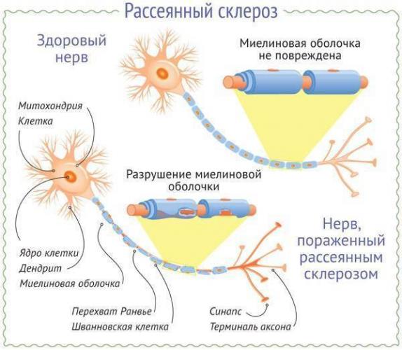 Причины миоза (суженных зрачков)