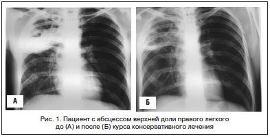 Признаки абсцедирующей пневмонии: диагностика, лечение, прогноз