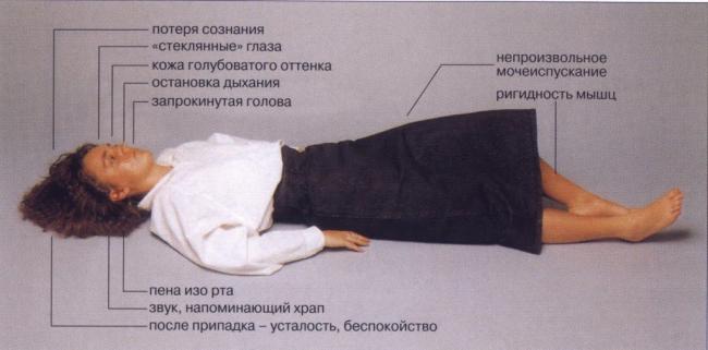 Виды эпилепсии
