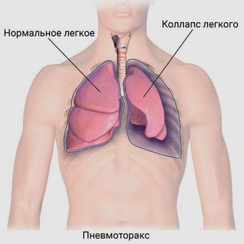 Свистящий кашель
