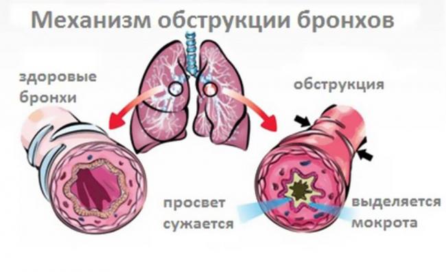 Пневмония и воспаление легких: одно и то же или различные патологии?