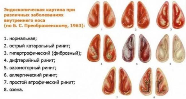 Как лечат хронический тонзиллит. лечение народными средствами