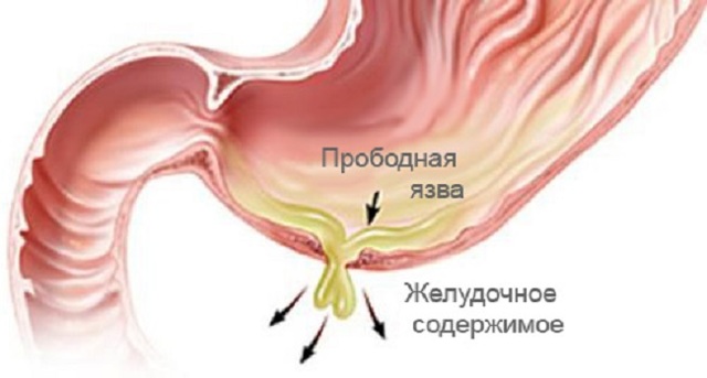 Осложнения язвенной болезни.