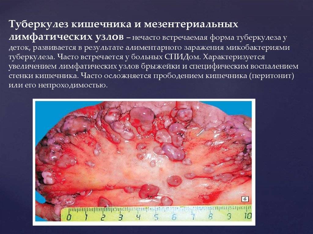 Туберкулез лимфоузлов: симптомы, признаки, лечение