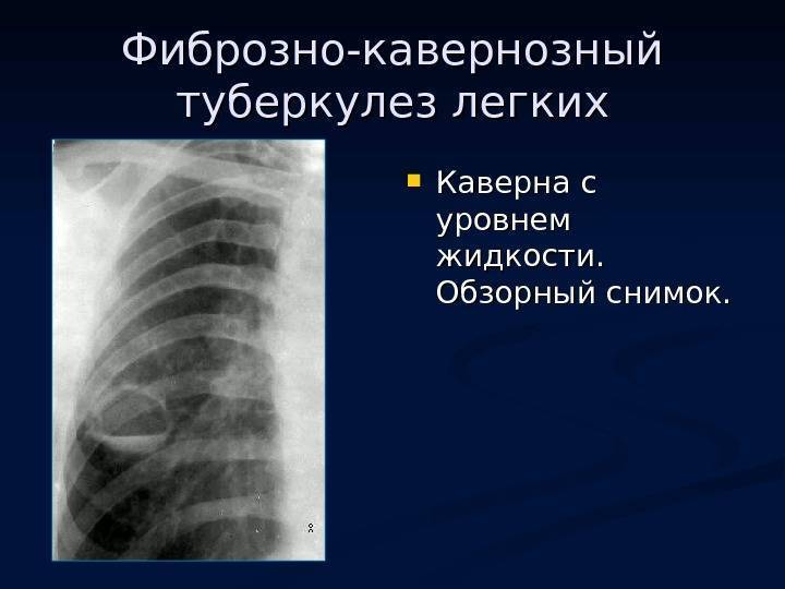 Что такое фиброзно-кавернозный туберкулез и как его лечить?