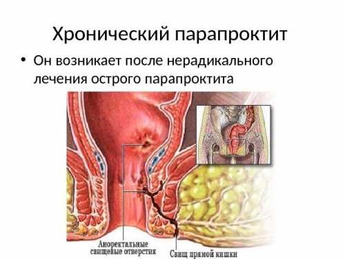 Парапроктит