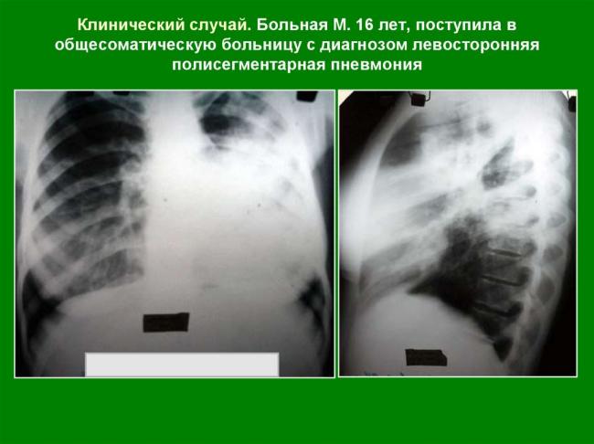 Возможен ли переход пневмонии в туберкулез