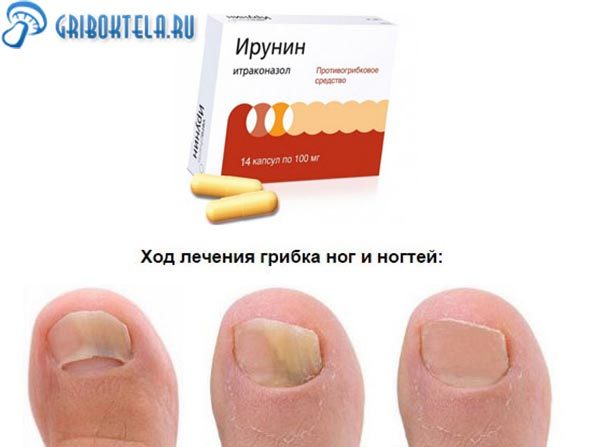 Орунгал от грибка ногтей