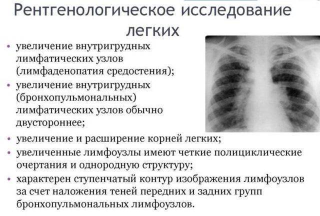 Пневмококк — симптомы, причины, виды, анализы и лечение пневмококковой инфекции
