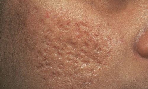 Рубцы на коже: лечение и профилактика образования