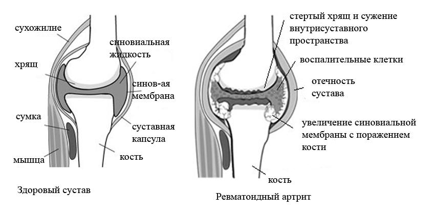 Ревматоидный артрит. причины, симптомы, современная диагностика и эффективное лечение болезни.