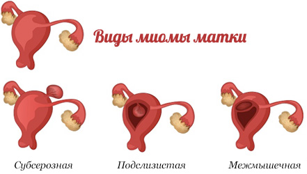 Диета при мастопатии молочных желез