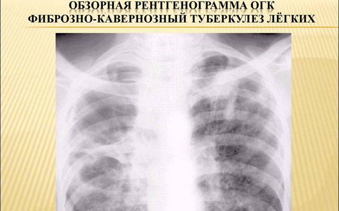 Что такое кавернозный туберкулез?