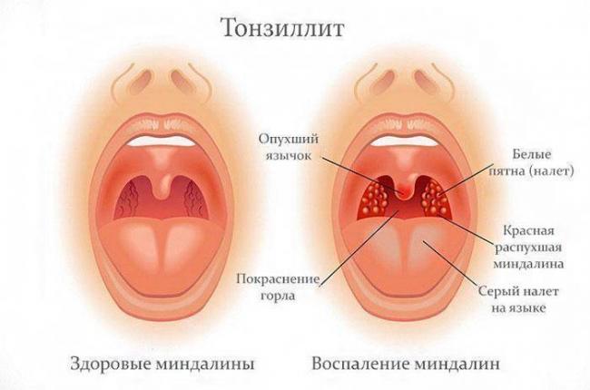 Болит горло при глотании с одной стороны: как и чем лечить