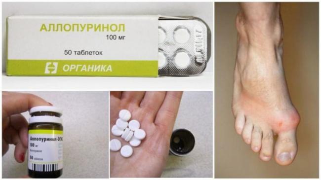 Аллопуринол эгис и милурит — что поменялось помимо названия лекарства.
