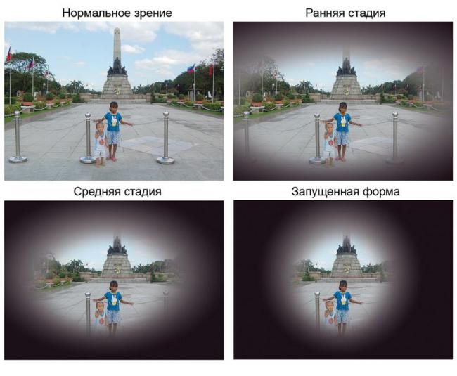 Аберрации высших порядков