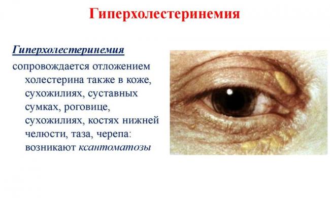Тразикор