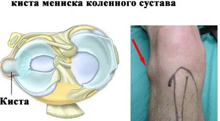 Гнойная шишка