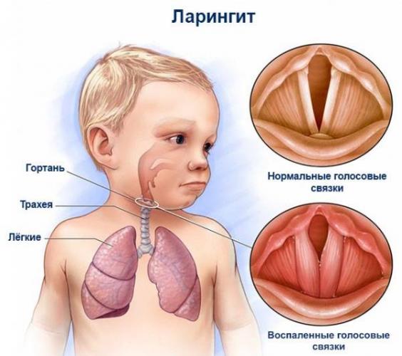 Что делать с кашлем? лечим кашель у ребенка
