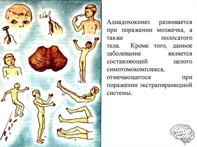 Адиадохокинез: причины, симптомы, лечение
