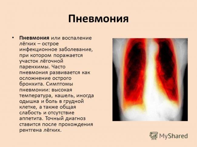 Болезнь пневмония – чем она опасна