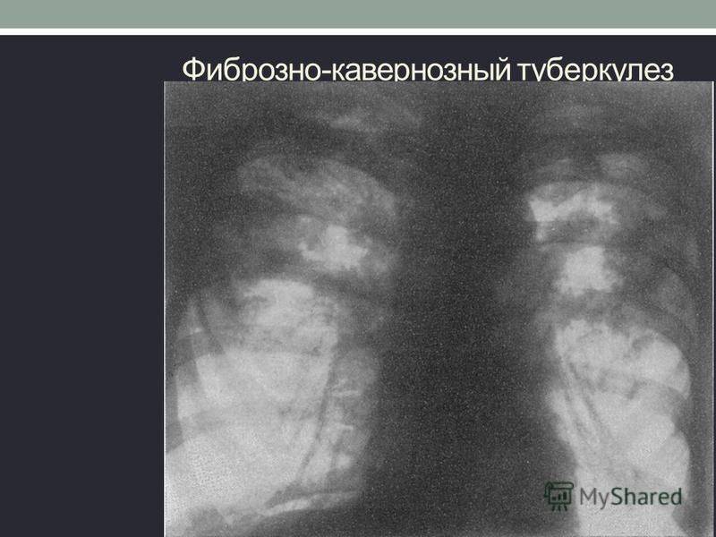 Кавернозный туберкулез: причины, симптомы формы его протекания