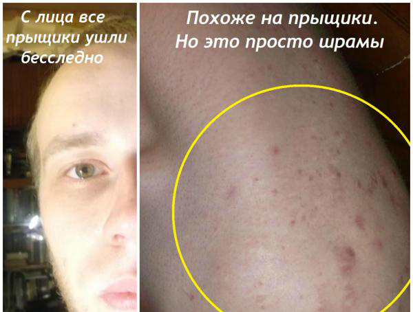 Преимущества мази бензилбензоат для лечения демодекоза