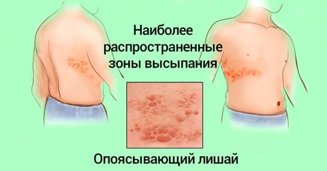 Изопринозин аналоги препарата при впч