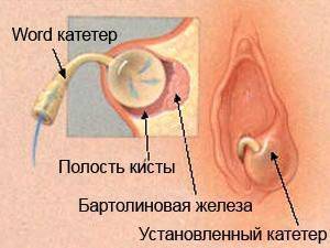 Бартолинит: что это такое и как лечить