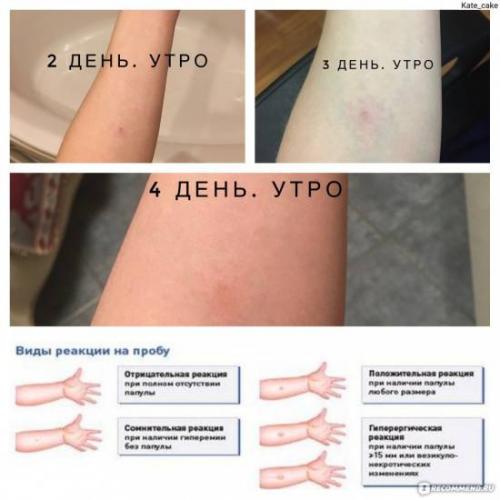 Синяк на месте диаскинтеста: нормально ли это и что делать?