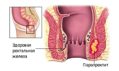 Парапроктит