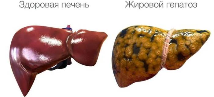 Какие фрукты можно есть при жировом гепатозе печени