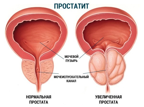 Курс лечения воспаления предстательной железы