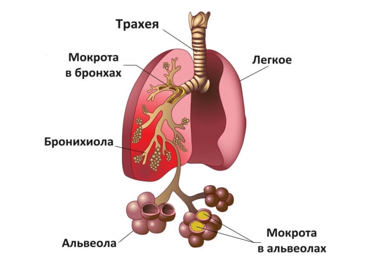 Атипичная пневмония у детей – немая: симптомы и лечение