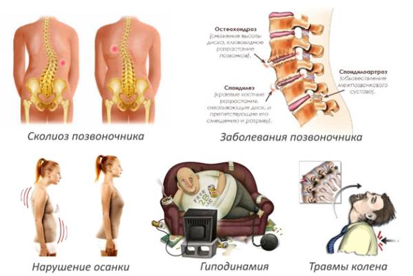 Грыжа диска с5 с6 шейного отдела позвоночника при остеохондрозе