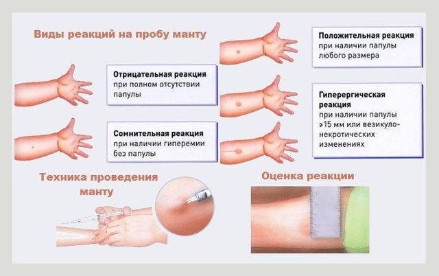 Реакция манту (проба) у детей. норма и вариации. туберкулинодиагностика. фото