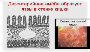 Что такое амебиаз кишечника, как передается и лечится