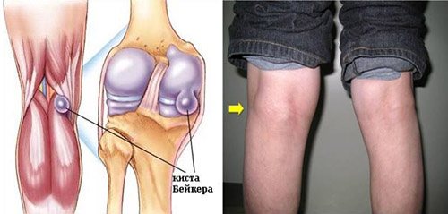 Гигрома у ребенка