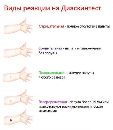 Диаскинтест
