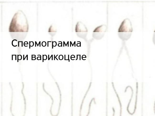 Варикоцеле, спермограмма