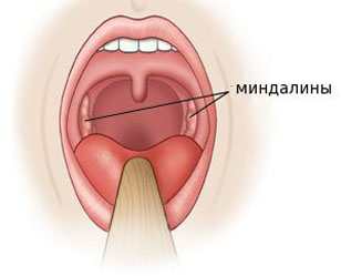 Паратонзиллярный абсцесс (паратонзиллит) - лечение
