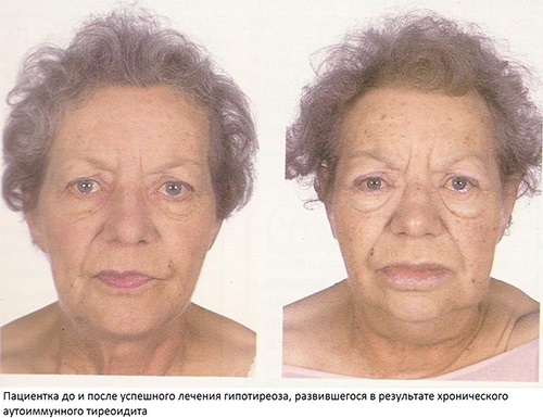Тиреоидит. причины, симптомы, диагностика и лечение болезни :: polismed.com