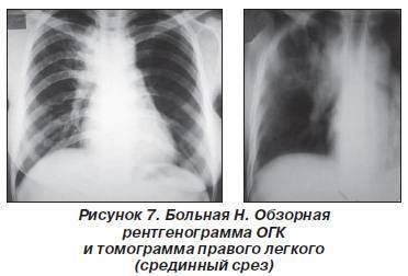 Какие лимфоузлы увеличиваются при туберкулезе