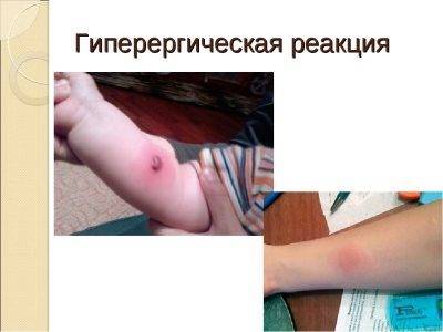 Диаскинтест: норма у детей и взрослых, фото с нормой и патологией