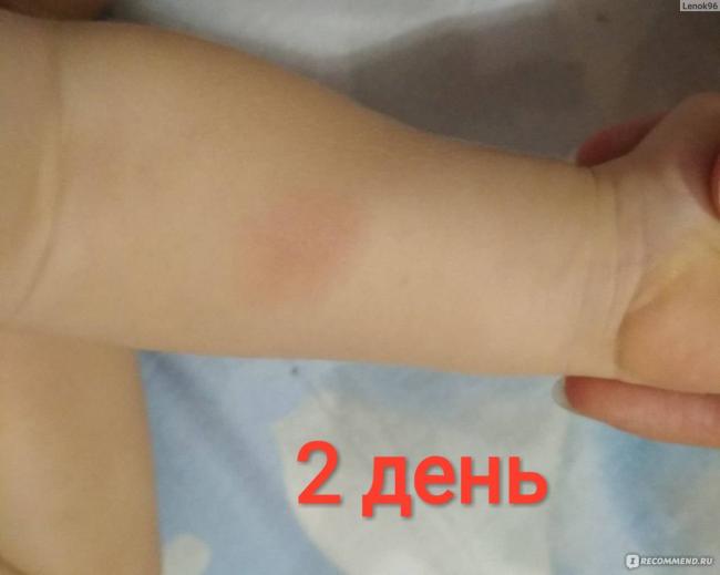 Что лучше: диаскинтест или проба манту
