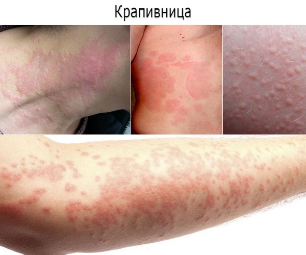 Крапивница у взрослых на теле: причины, симптомы, лечение, фото