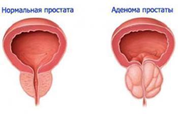 Лечение аденомы простаты препаратом омник – как правильно принимать таблетки?