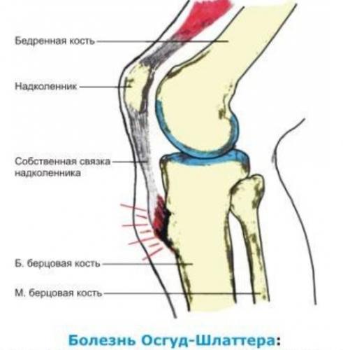 Болезнь шляттера: симптомы у подростков, лечение болезни шляттера коленного сустава