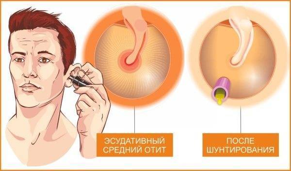 Что делать, если после простуды заложило ухо, как и чем лечить в домашних условиях