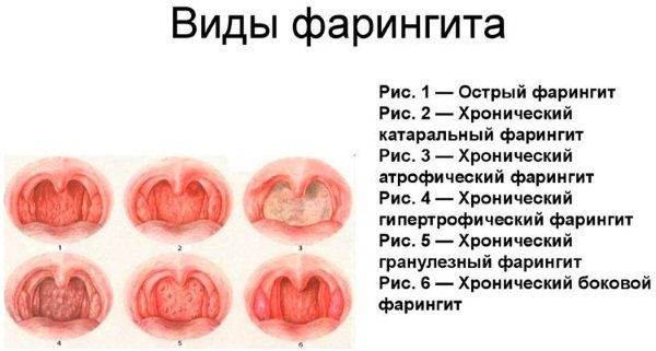 Фарингит, трахеит, ларингит: симптомы и лечение у детей и взрослых | тонзиллитик.ру